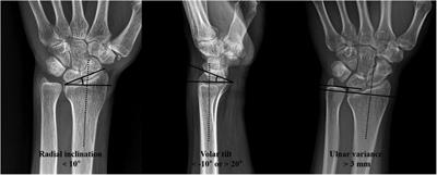 Forearm bone mineral density as a predictor of reduction loss in distal radius fractures treated with cast immobilization